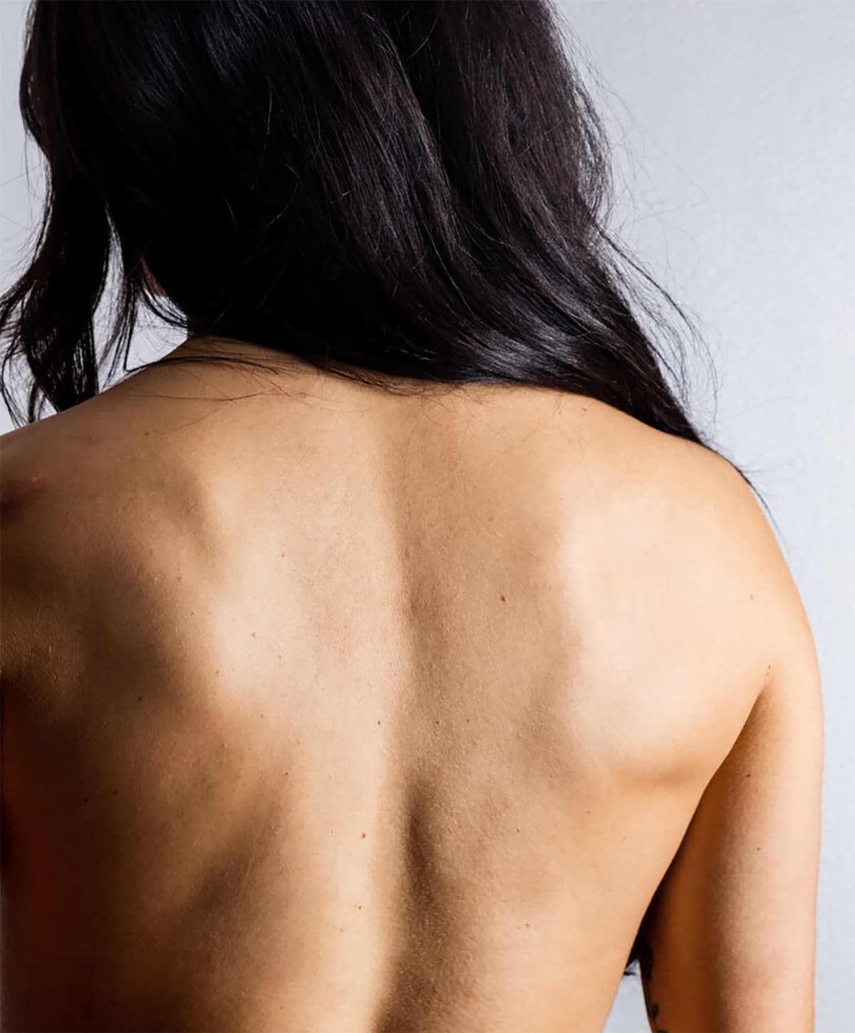 Boca Raton laser tattoo removal model in chair