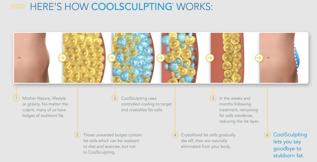 CoolSculpting Boca Raton informational diagram