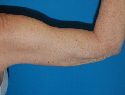 Arm Lift Before & After Image