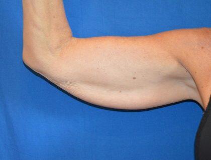 Arm Lift Before & After Image