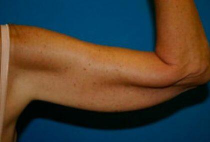 Arm Lift Before & After Image