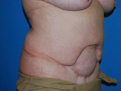 Corrective Tummy Tuck Before & After Image