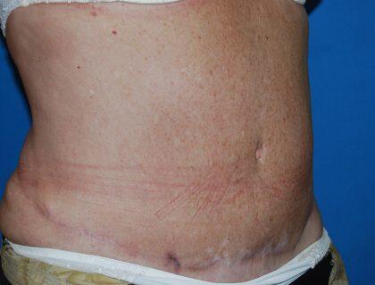 Corrective Tummy Tuck Before & After Image