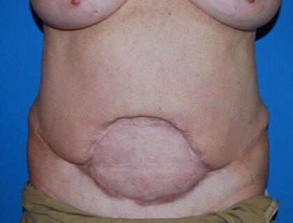 Corrective Tummy Tuck Before & After Image