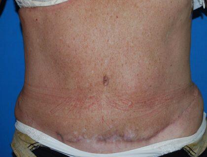 Corrective Tummy Tuck Before & After Image