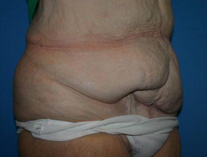 Corrective Tummy Tuck Before & After Image