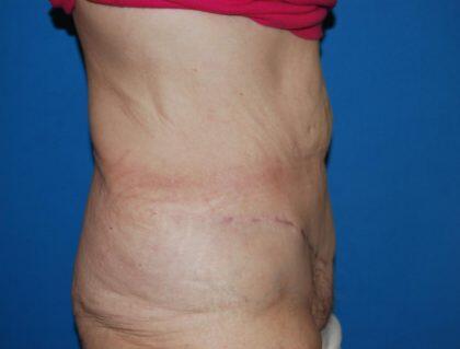 Corrective Tummy Tuck Before & After Image