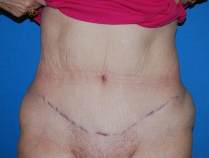 Corrective Tummy Tuck Before & After Image
