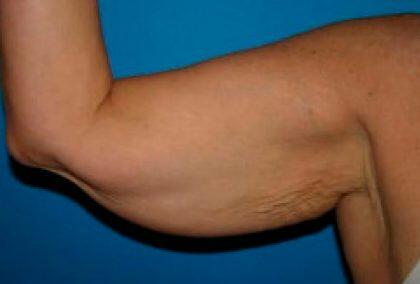 Full Arm Lift Before & After Image