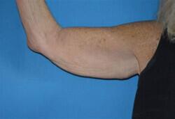 Full Arm Lift Before & After Image