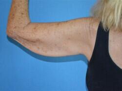 Full Arm Lift Before & After Image
