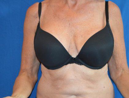 Full Arm Lift Before & After Image