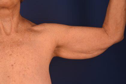 Full Arm Lift Before & After Image