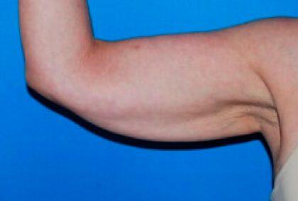 Full Arm Lift Before & After Image