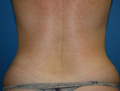 Liposuction Before & After Image