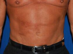 Liposuction Before & After Image