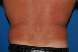 Liposuction Before & After Image