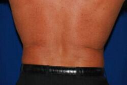 Liposuction Before & After Image