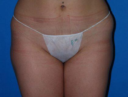 Liposuction Before & After Image