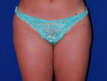 Liposuction Before & After Image