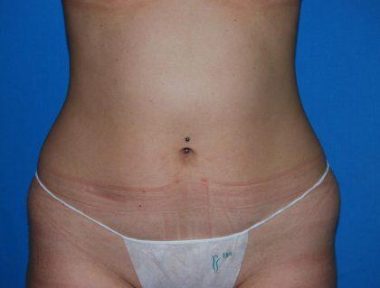 Liposuction Before & After Image