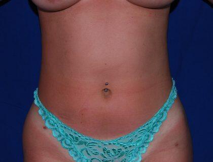 Liposuction Before & After Image