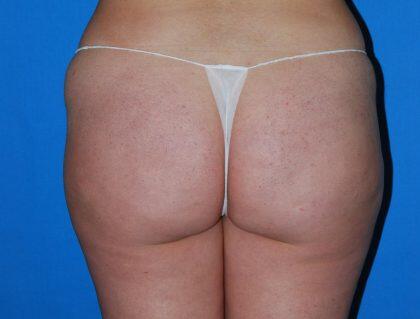 Liposuction Before & After Image