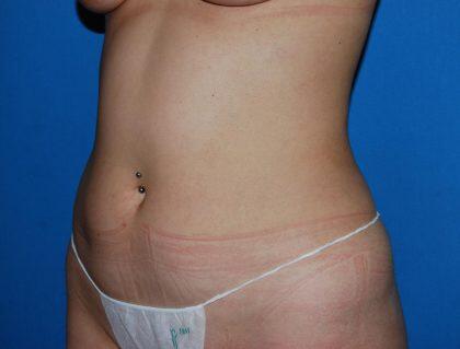 Liposuction Before & After Image