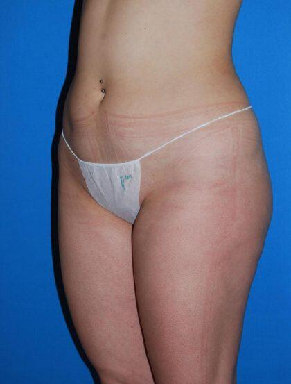 Liposuction Before & After Image
