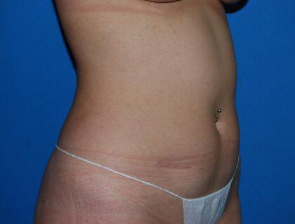 Liposuction Before & After Image
