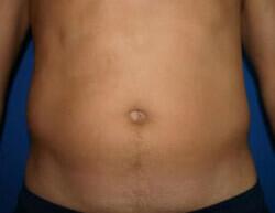 Liposuction Before & After Image