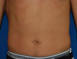 Liposuction Before & After Image