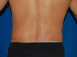 Liposuction Before & After Image