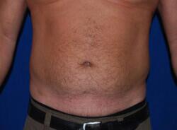 Liposuction Before & After Image