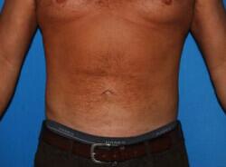 Liposuction Before & After Image