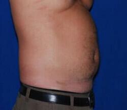 Liposuction Before & After Image