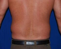 Liposuction Before & After Image