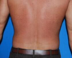 Liposuction Before & After Image