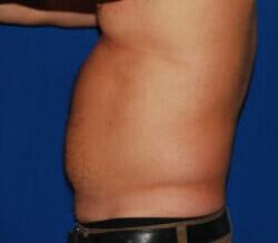 Liposuction Before & After Image