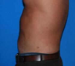Liposuction Before & After Image