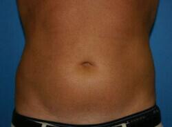 Liposuction Before & After Image