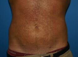 Liposuction Before & After Image