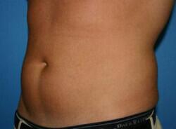 Liposuction Before & After Image