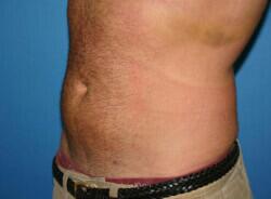 Liposuction Before & After Image