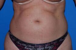 Liposuction Before & After Image