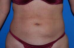 Liposuction Before & After Image