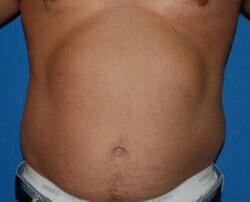 Liposuction Before & After Image