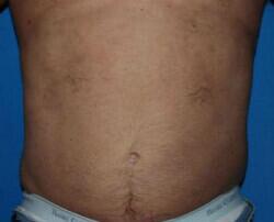 Liposuction Before & After Image