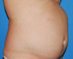 Liposuction Before & After Image