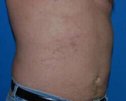 Liposuction Before & After Image